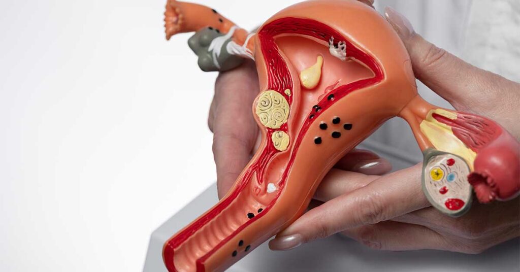 cid D25 Mioma uterino